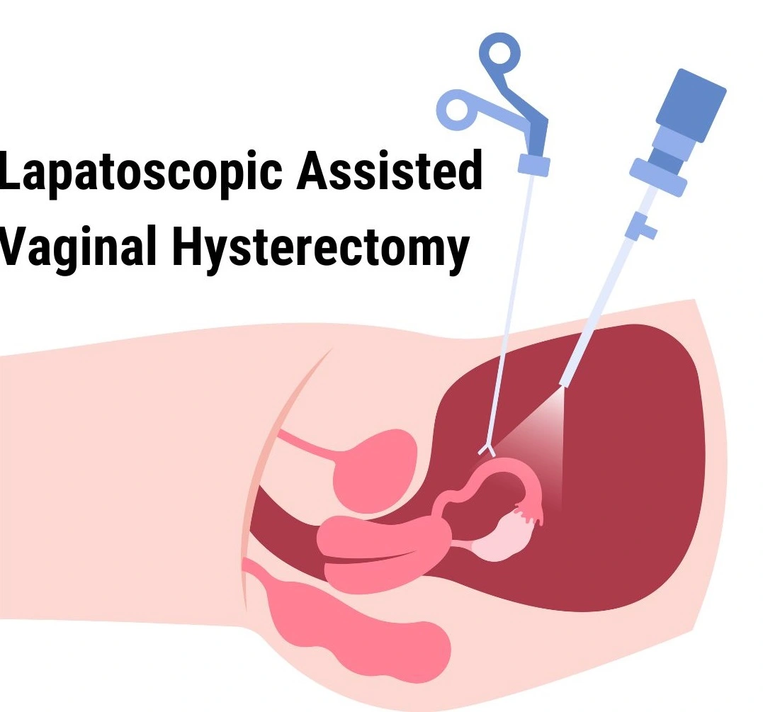 Lapatoscopic Assisted Vaginal Hysterectomy