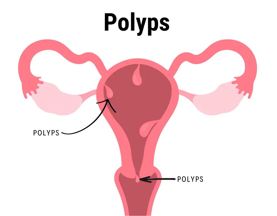 Polyps