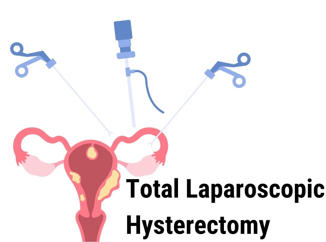 Total Laparoscopic Hysterectomy