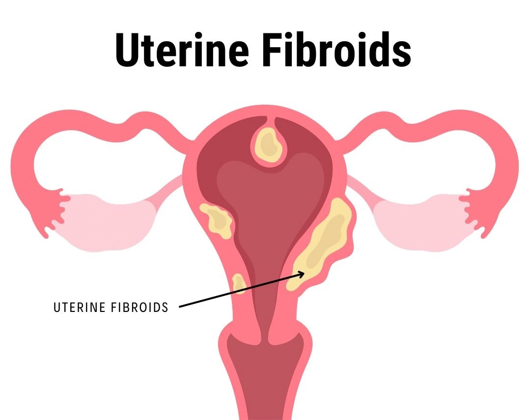 Uterine Fibroids