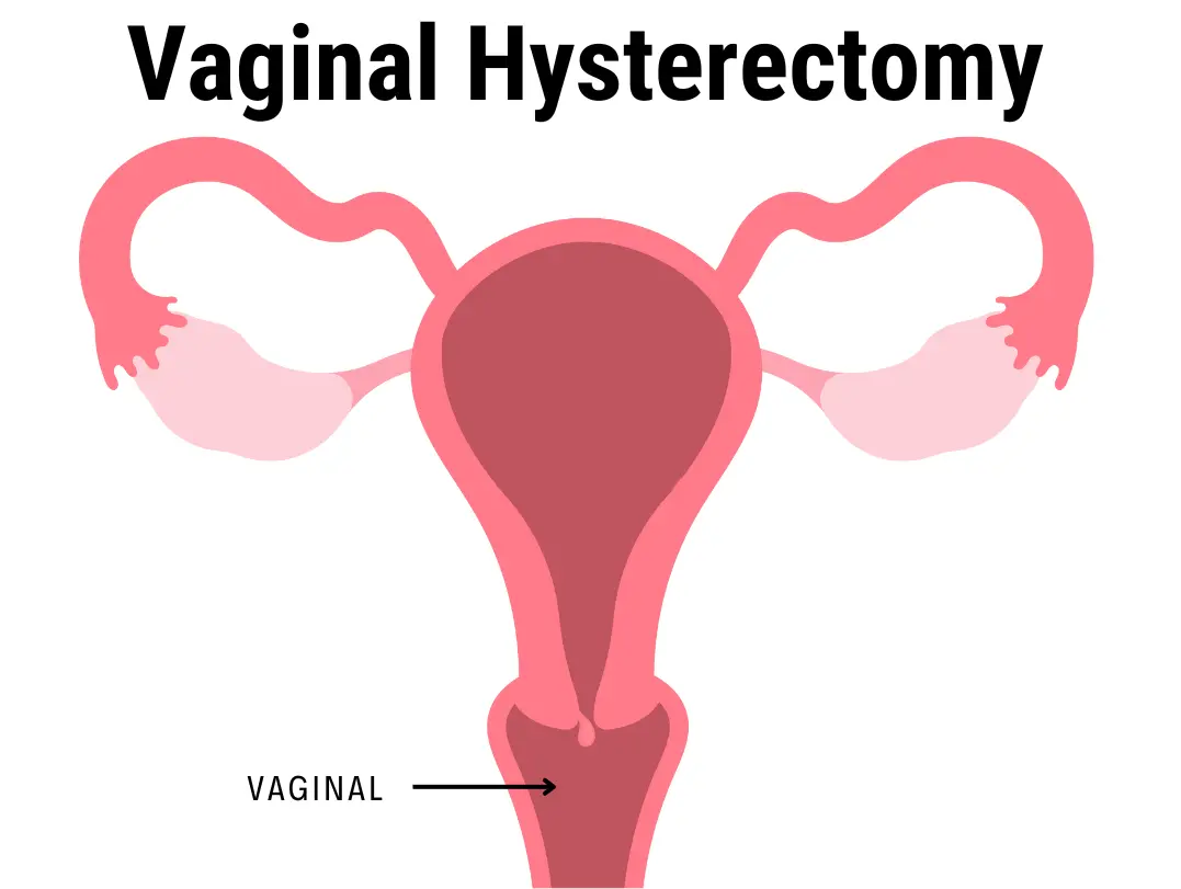 Vaginal Hysterectomy