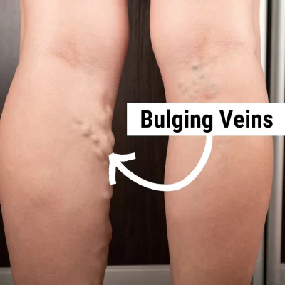 Bulging Veins