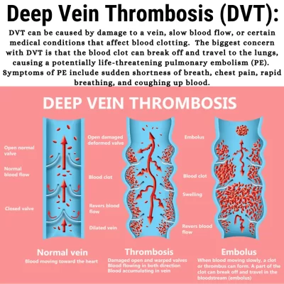 Deep Vein Thrombosis (DVT)