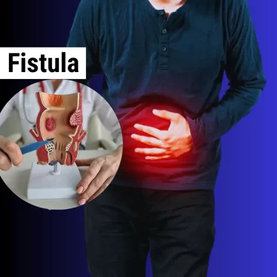 FISTULA - BL Tiwari Hospital