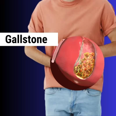 Gallstone