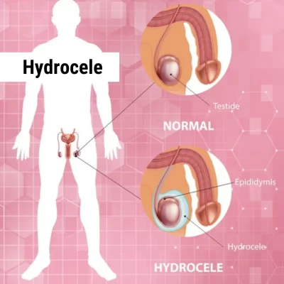 Hydrocele