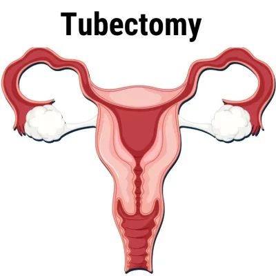 Tubectomy