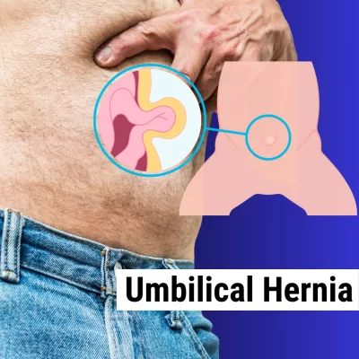 Umbilical Hernia