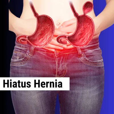 Hiatus Hernia